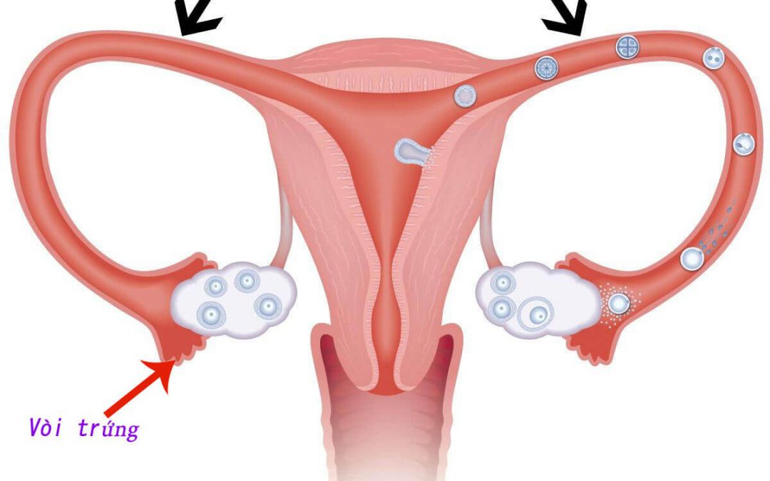 Tắc vòi trứng – một trong những nguyên nhân gây vô sinh phổ biến ở nữ giới