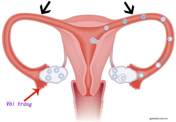 Tắc vòi trứng nguyên nhân gây vô sinh ở phụ nữ
